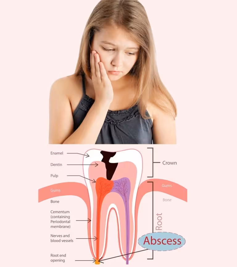 Abscessed Tooth In Children Causes, Symptoms And Treatment