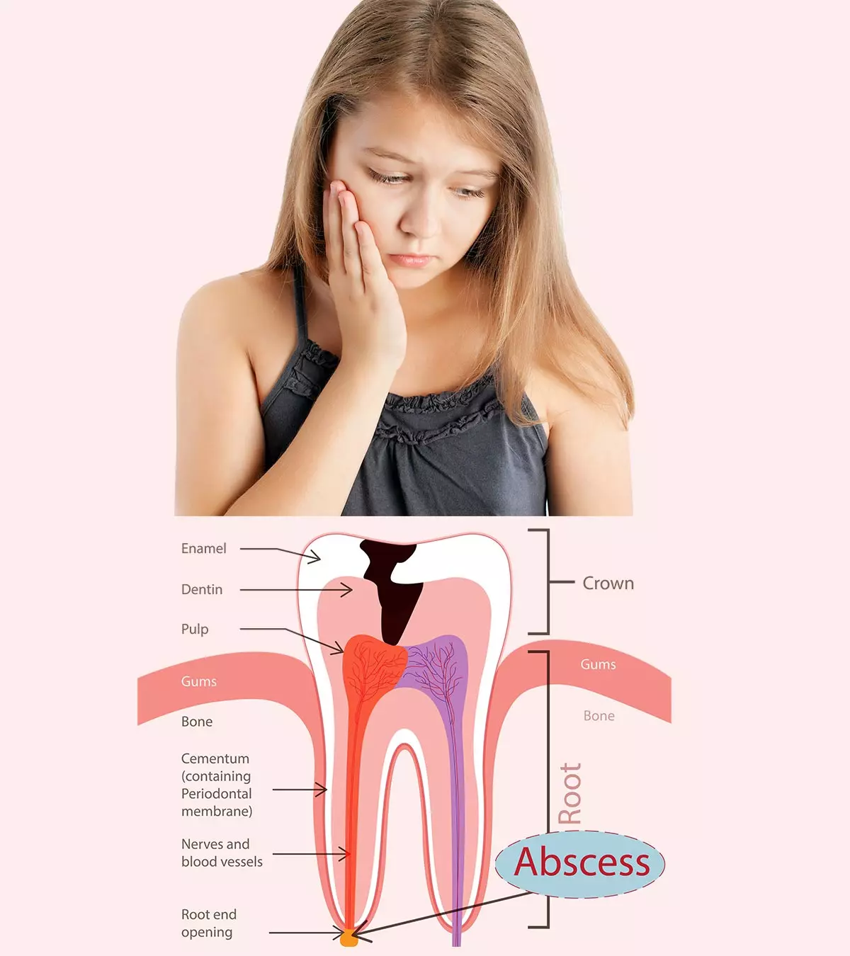 Abscessed Tooth In Child: Causes, Symptoms, Care & Treatment_image