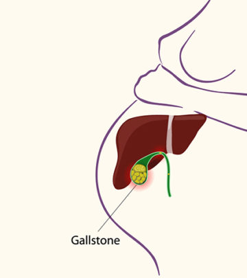 Gallstones During Pregnancy - Everything You Need To Know