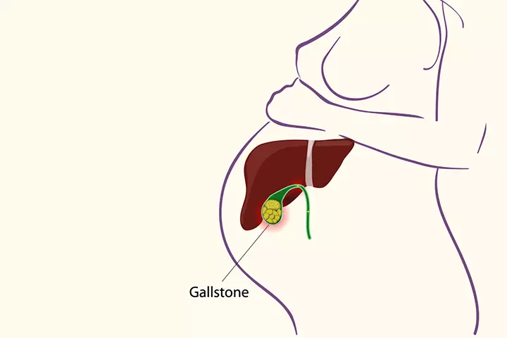 Gallstones During Pregnancy – Everything You Need To Know_image