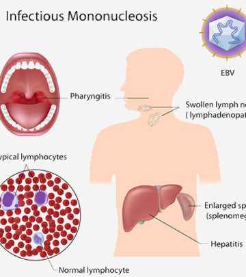 15 Serious Symptoms Of Mononucleosis In Children_image