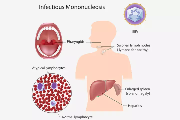 15 Serious Symptoms Of Mononucleosis In Children_image