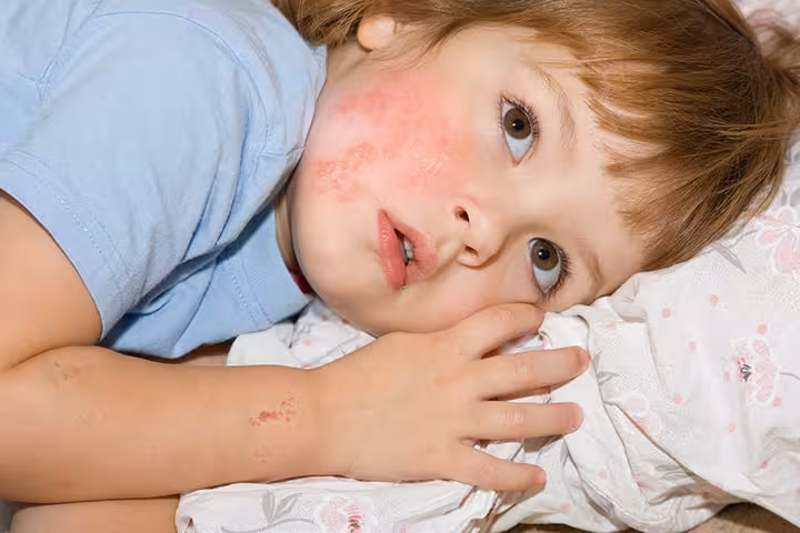 Shingles In Children Serious-Signs-And-Symptoms-Of-Shingles-In-Children