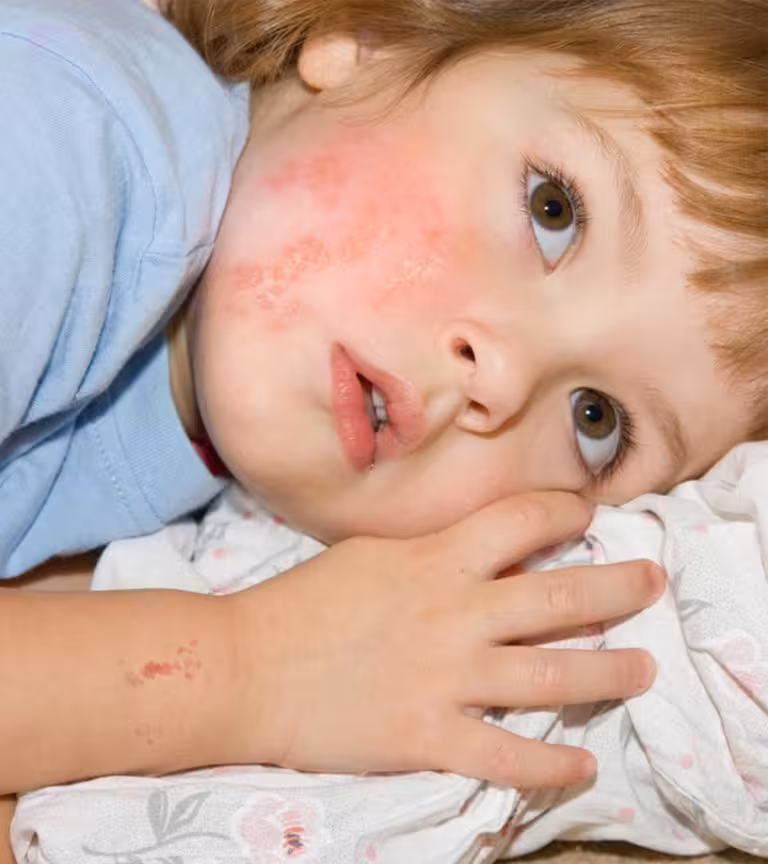 Shingles In Children Causes, Symptoms And Home Remedies