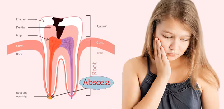 Abscessed Tooth In Child - Pictures Abscessed Tooth In Child - Images