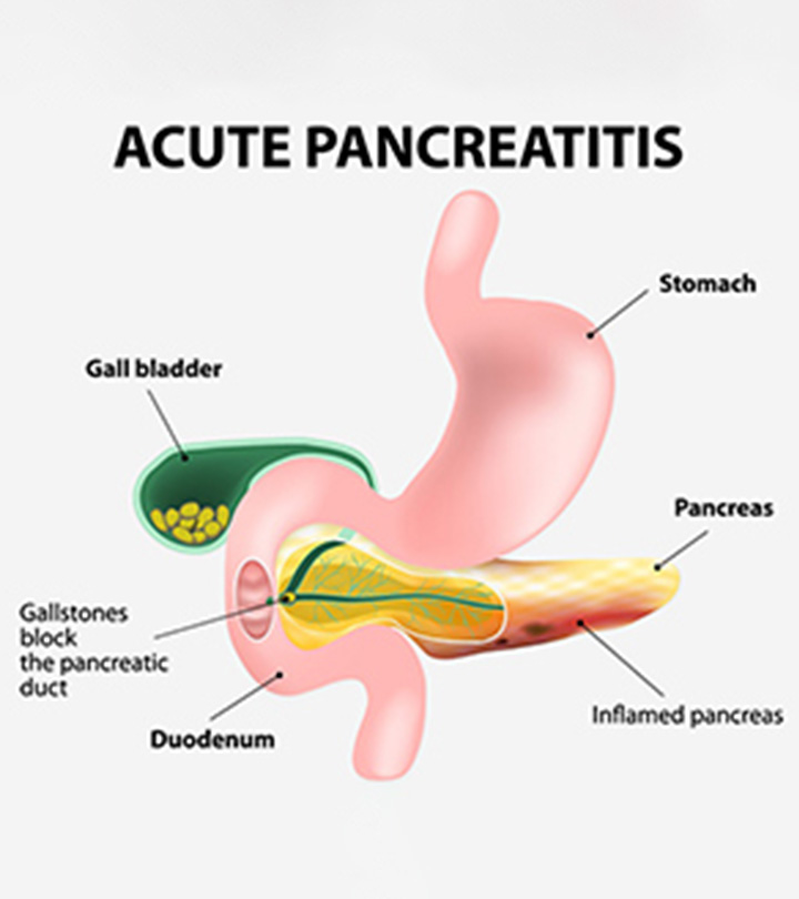 Acute Pancreatitis In Children – Causes & Symptoms_image