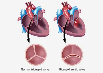 Congenital Heart Disease In Kids – Causes, Symptoms & Treatment_image