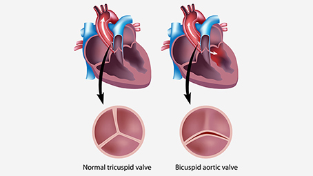 Congenital Heart Disease In Kids – Causes, Symptoms & Treatment_image