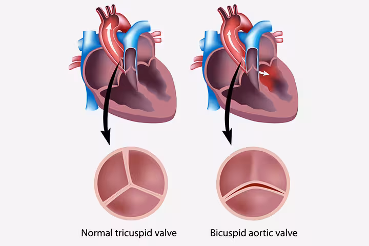 Congenital Heart Disease In Children Congenital-Heart-Disease-In-Kids