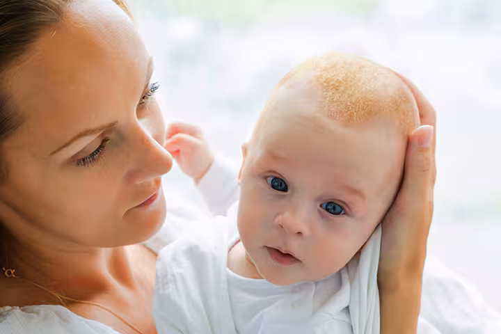 Cradle Cap In Babies Cradle Cap For Babies