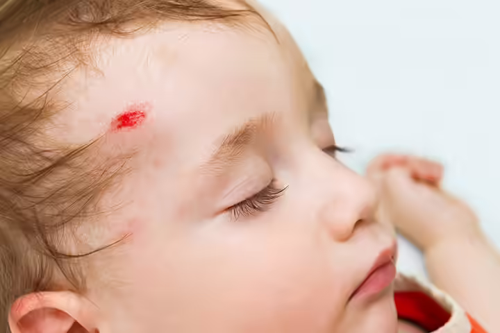 Head Injuries In Babies Head Injuries In Babies