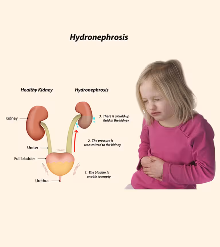 Hydronephrosis-In-Children