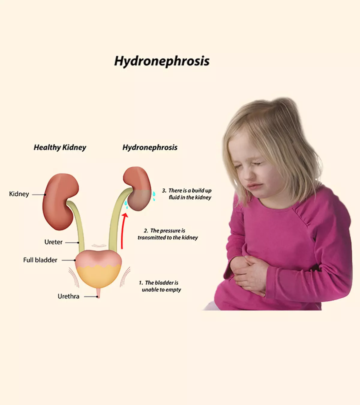 Hydronephrosis In Children – Causes, Symptoms And Treatment_image