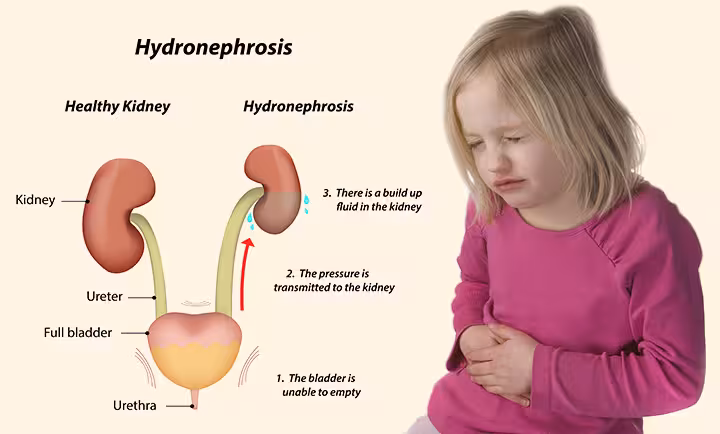 Hydronephrosis In Children Hydronephrosis In Children
