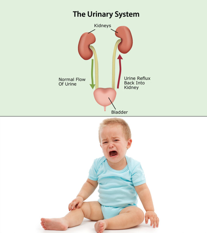 Kidney Reflux In Babies