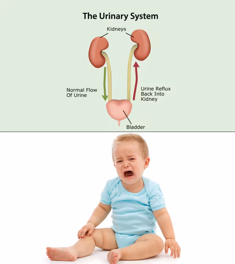 Kidney Reflux In Babies
