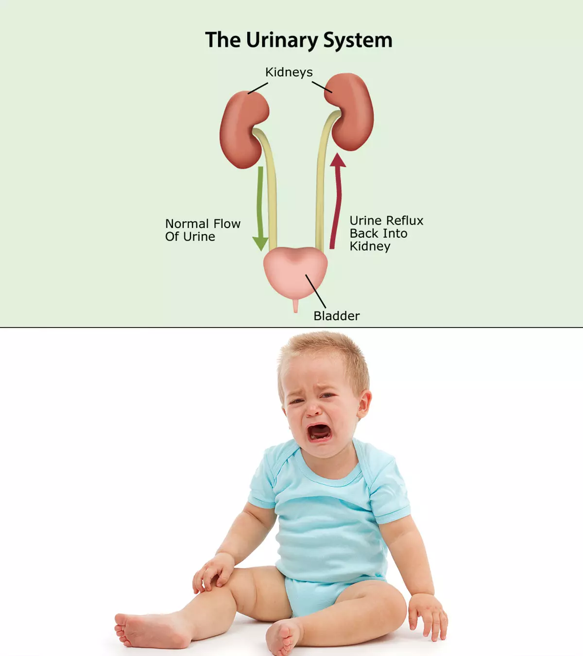 Kidney Reflux In Babies – Everything You Need To Know_image