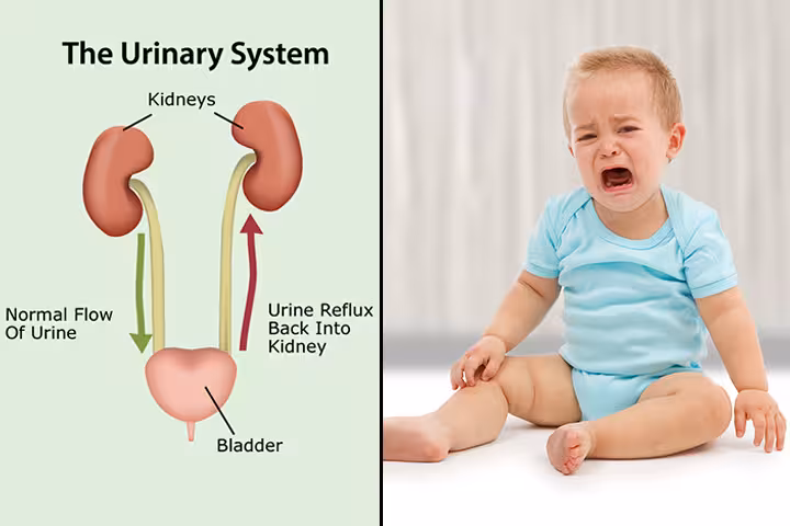 Kidney Reflux In Babies Kidney Reflux In Babies