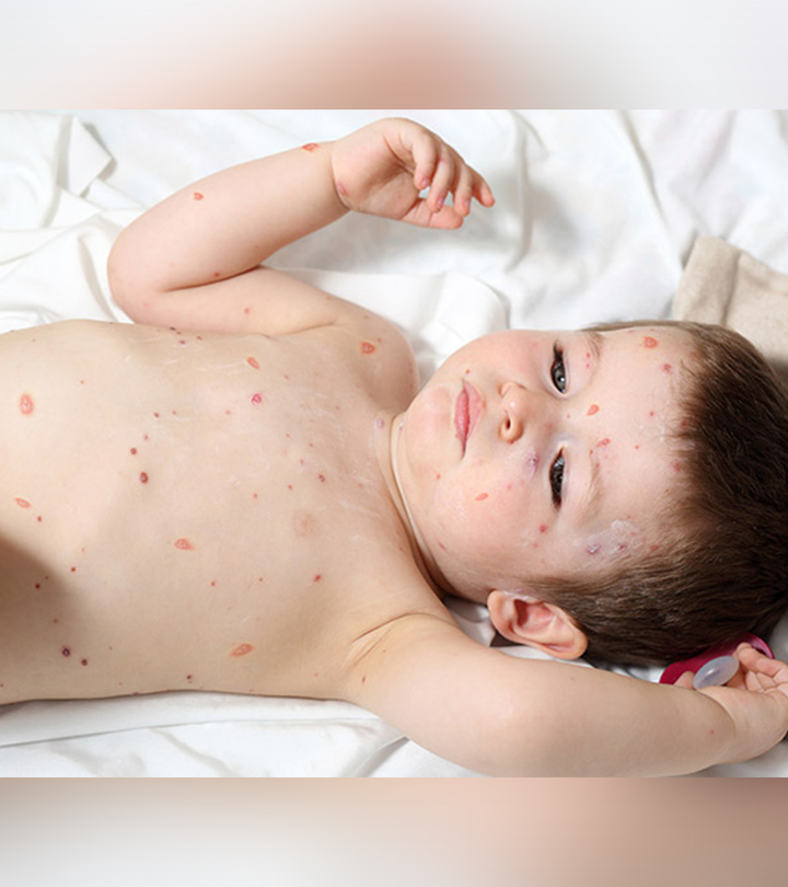 Scabies In Toddlers – Causes, Symptoms & Treatments You Should Be Aware Of_image