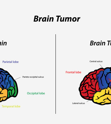 Brain Tumors In Toddlers – Causes, Symptoms & Treatments