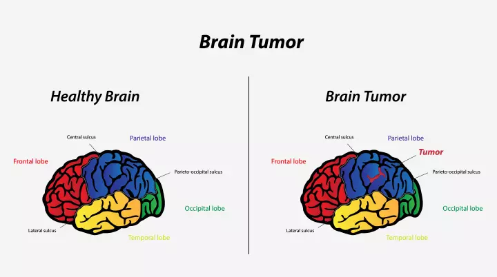 Brain Tumors In Toddlers – Causes, Symptoms & Treatments_image