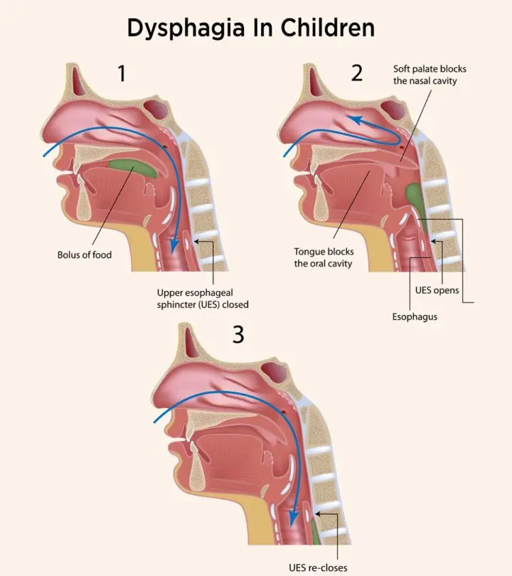 Dysphagia-In-Children