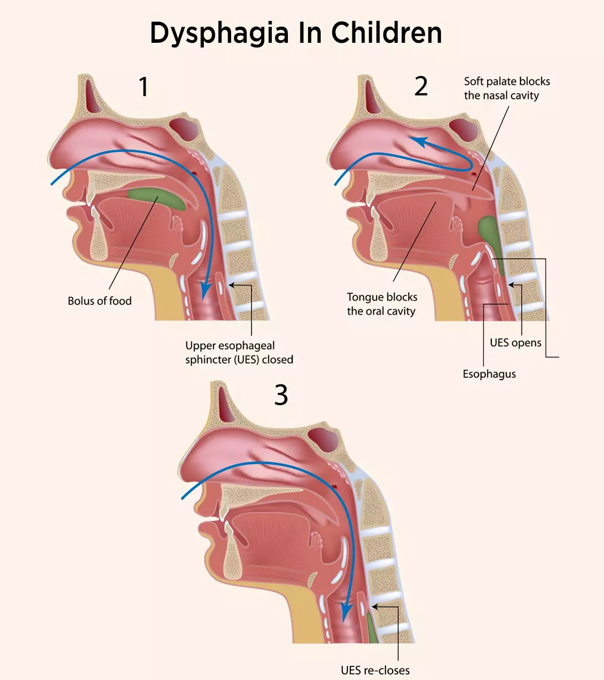 Dysphagia In Children – Causes, Symptoms & Treatment_image