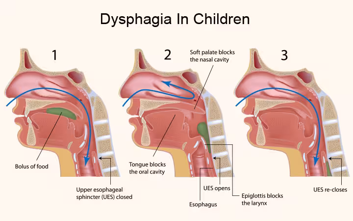Dysphagia In Children Dysphagia In Children