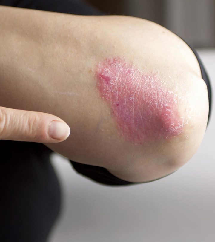 Eczema In Teens Causes, Symptoms And Remedies