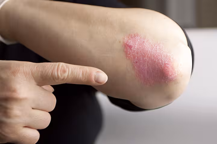 Eczema In Teens Eczema In Teens