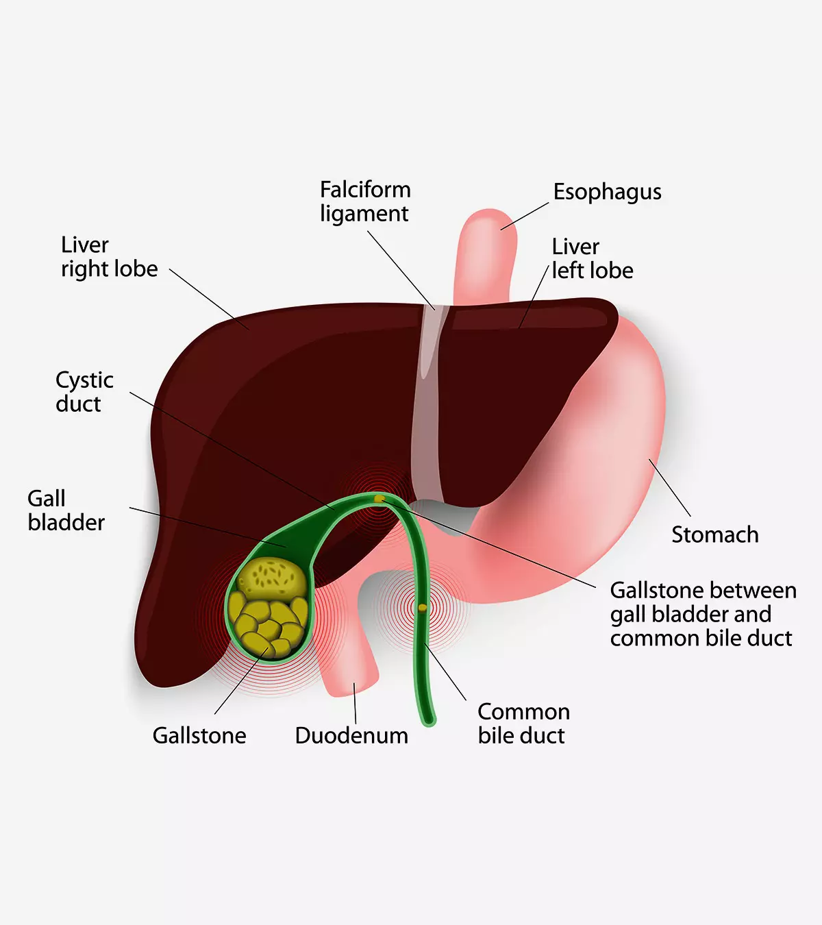 Gallstones In Children – Everything You Need To Know_image