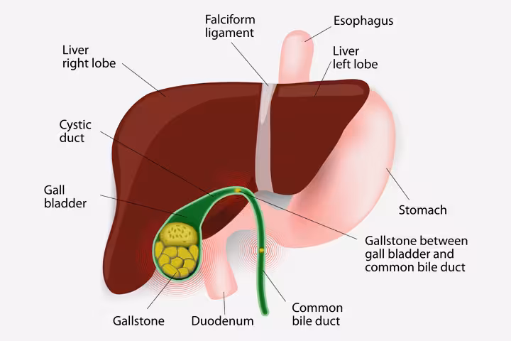 Gallstones In Children Gallstones