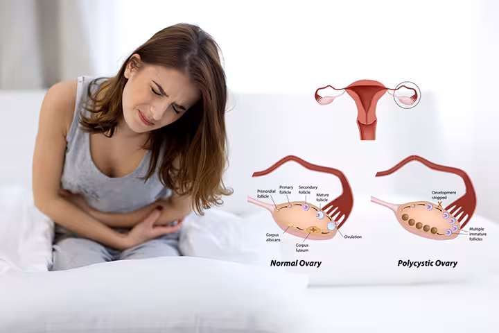 Polycystic Ovary Syndrome