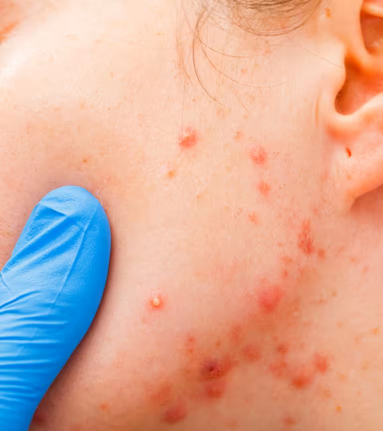Acne-In-Children
