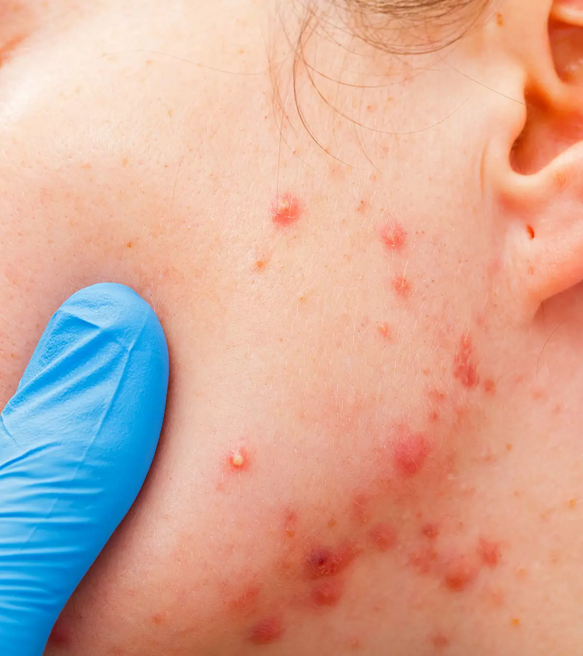 Acne In Children – Causes, Symptoms & Treatments You Should Be Aware Of_image