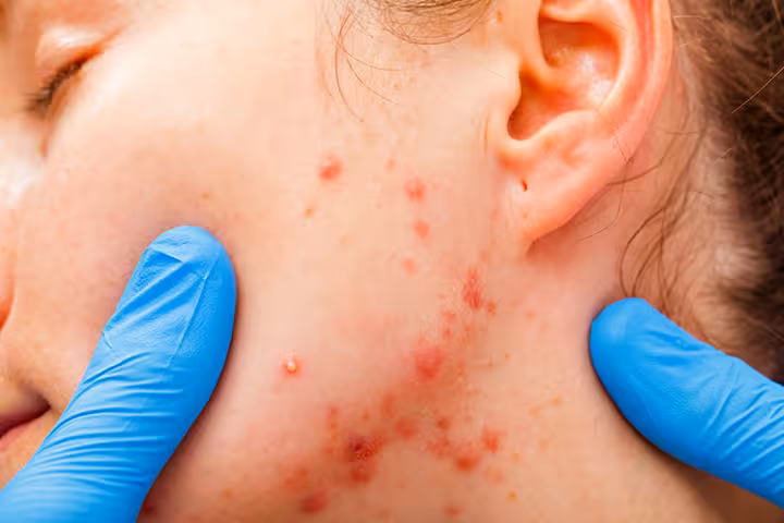 Acne In Children Acne In Children