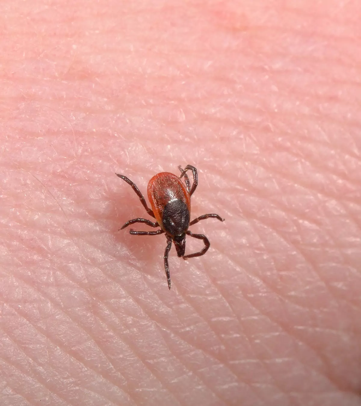 Lyme Disease In Babies – Everything You Need To Know_image