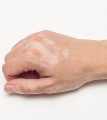 Vitiligo In Children – Prevention And Treatment