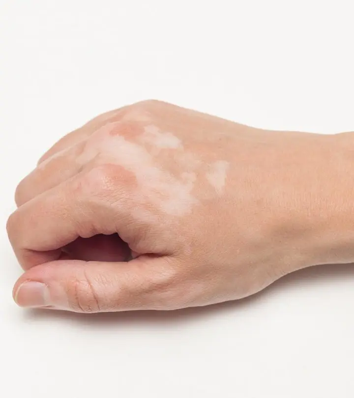 Vitiligo In Children – Prevention And Treatment