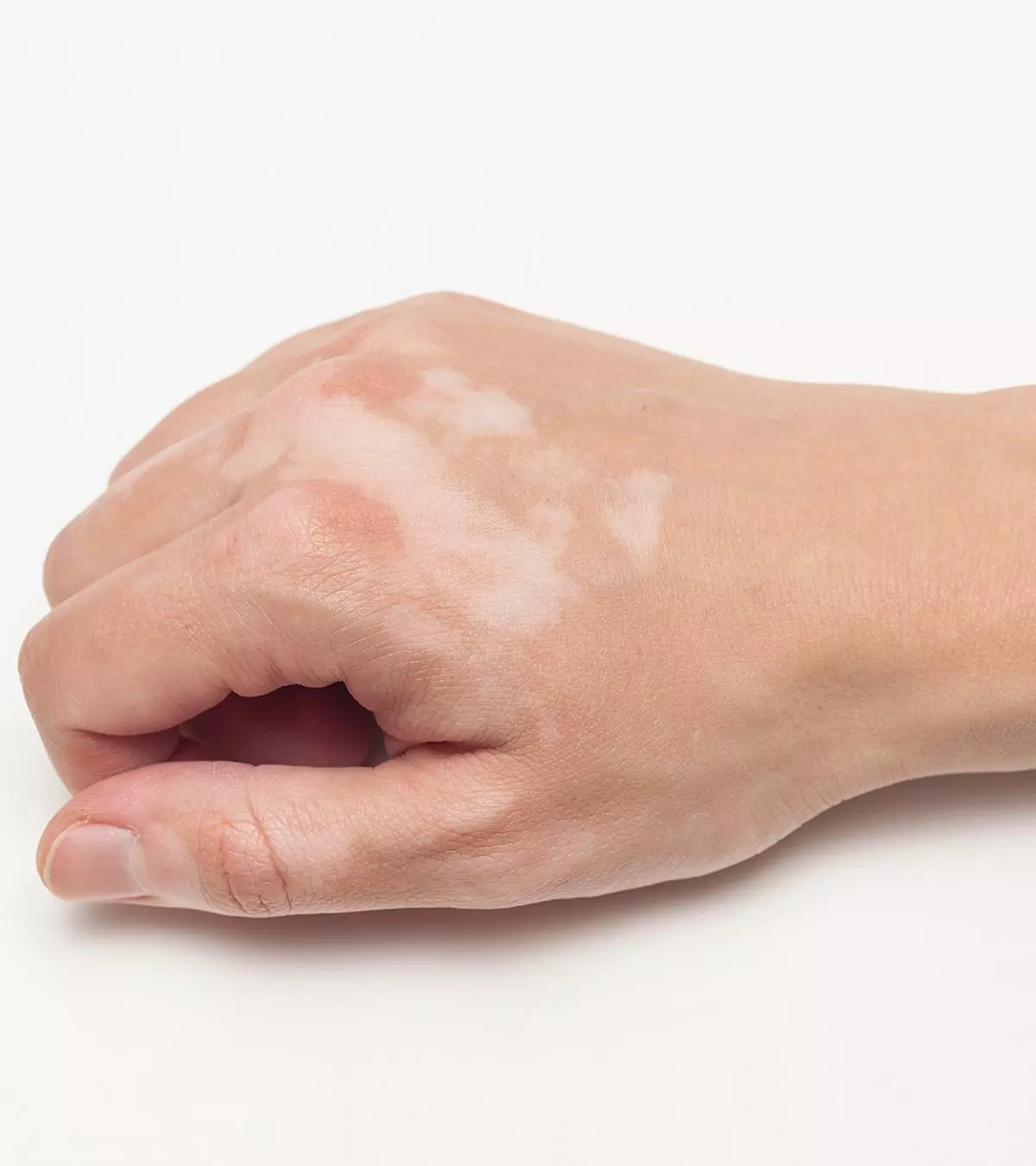 Vitiligo In Children – Prevention And Treatment_image