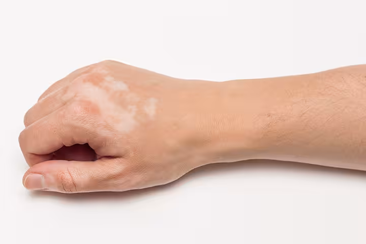 vitiligo in children photos vitiligo in children photos