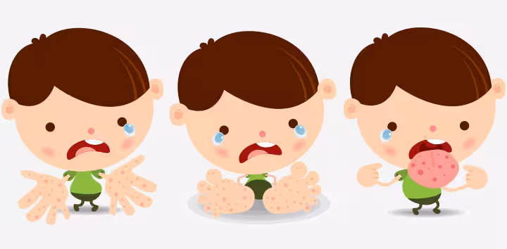 Coxsackievirus In Children Coxsackievirus In Children