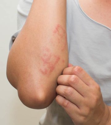 How To Use Apple Cider Vinegar For Eczema