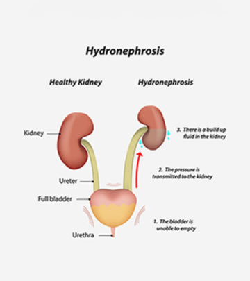 Hydronephrosis In Infants – 5 Causes, 7 Symptoms & 3 Treatments You Should Be Aware Of_image