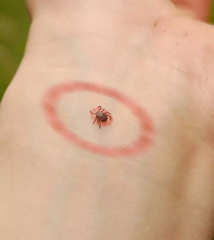 Lyme Disease In Toddlers