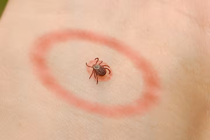 Lyme-Disease-In-Toddlers