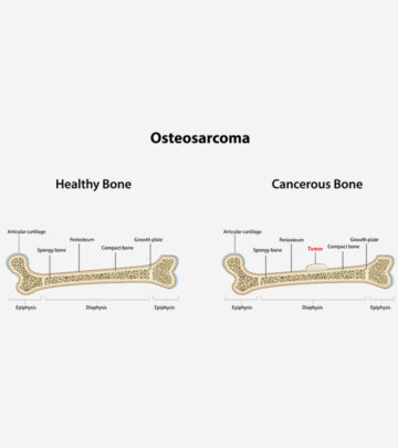 Osteosarcoma In Children