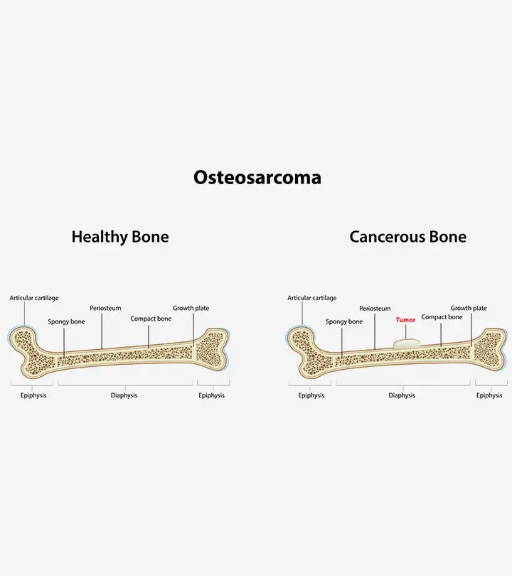 Osteosarcoma In Children – Symptoms And Treatment_image