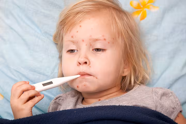 Chickenpox In Children Chickenpox In Children
