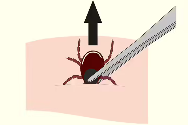 How To Remove A Tick How To Remove A Tick